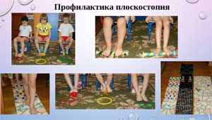 Проект «Профилактика плоскостопия в детском саду»
