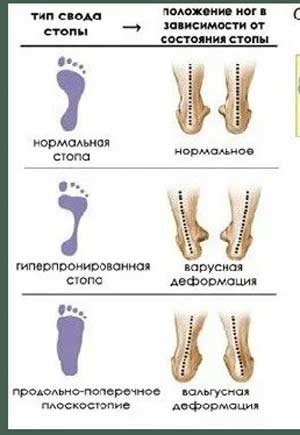 Плоскостопие, причины плоскостопия