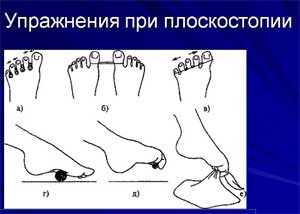 «Комплекс упражнений при плоскостопии»